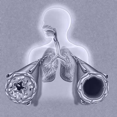 airway congestion